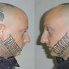 8461 - Tattoo Failure