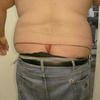 8372 - Tattoo Failure