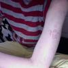 8461 - Tattoo Failure